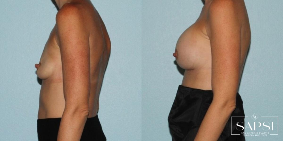 Breast Augmentation: Patient 10 - Before and After 3