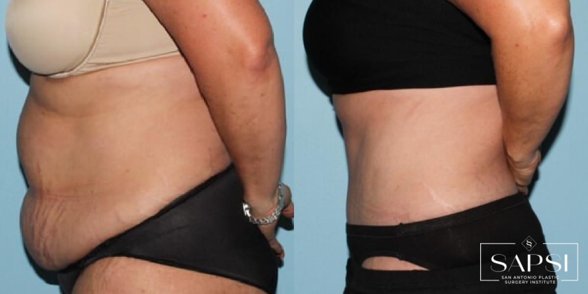 Tummy Tuck: Patient 30 - Before and After 3