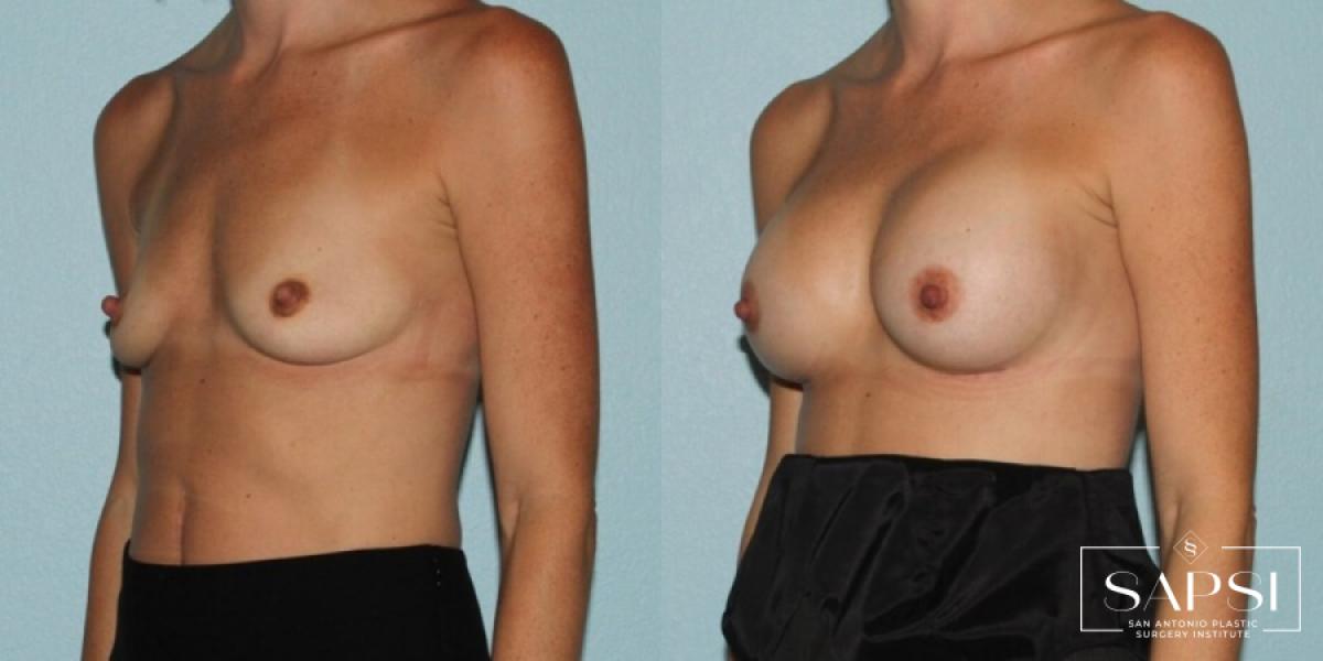 Breast Augmentation: Patient 10 - Before and After 2