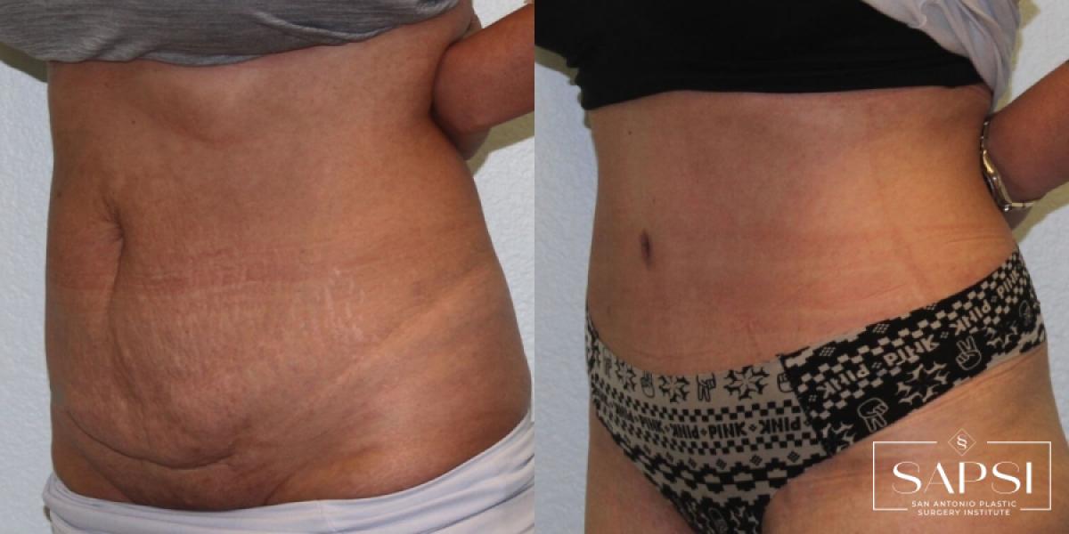 Tummy Tuck: Patient 23 - Before and After 2