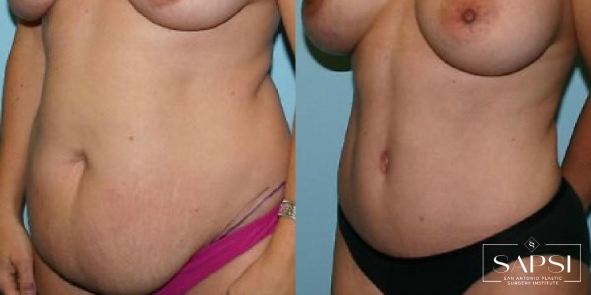 Tummy Tuck: Patient 40 - Before and After 2