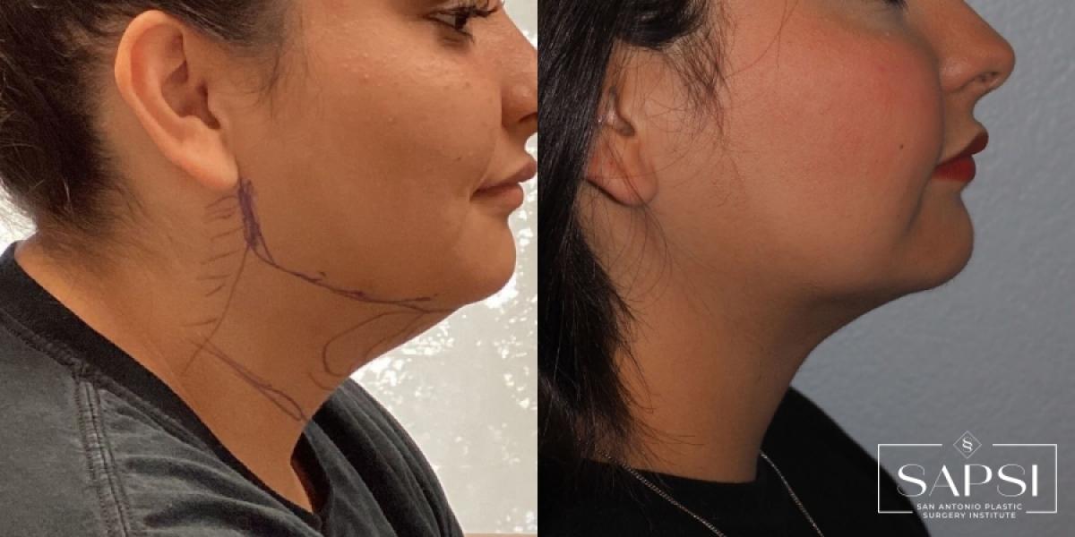 Liposuction: Patient 3 - Before and After 3