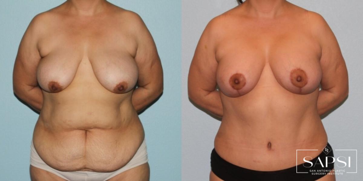 Breast Augmentation With Lift: Patient 6 - Before and After  