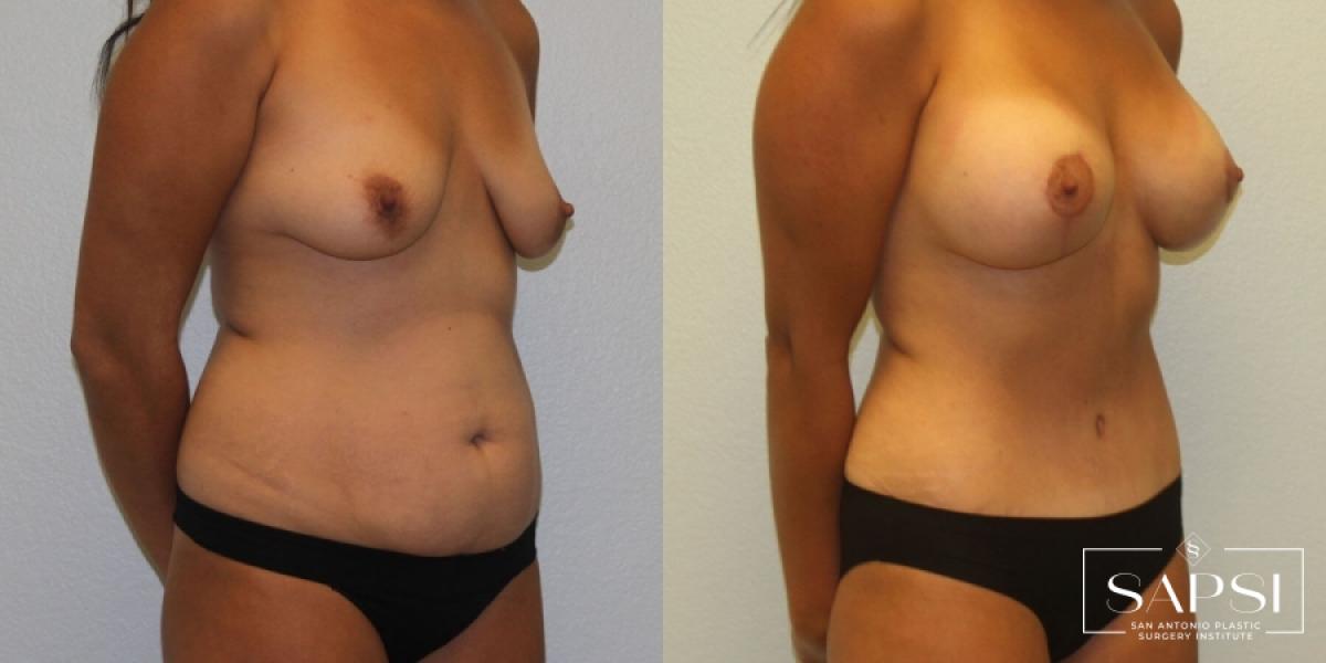 Breast Lift: Patient 1 - Before and After 2