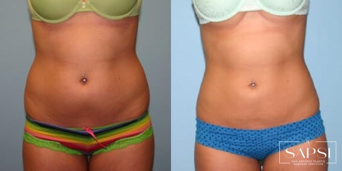 Liposuction: Patient 12 - Before and After 1