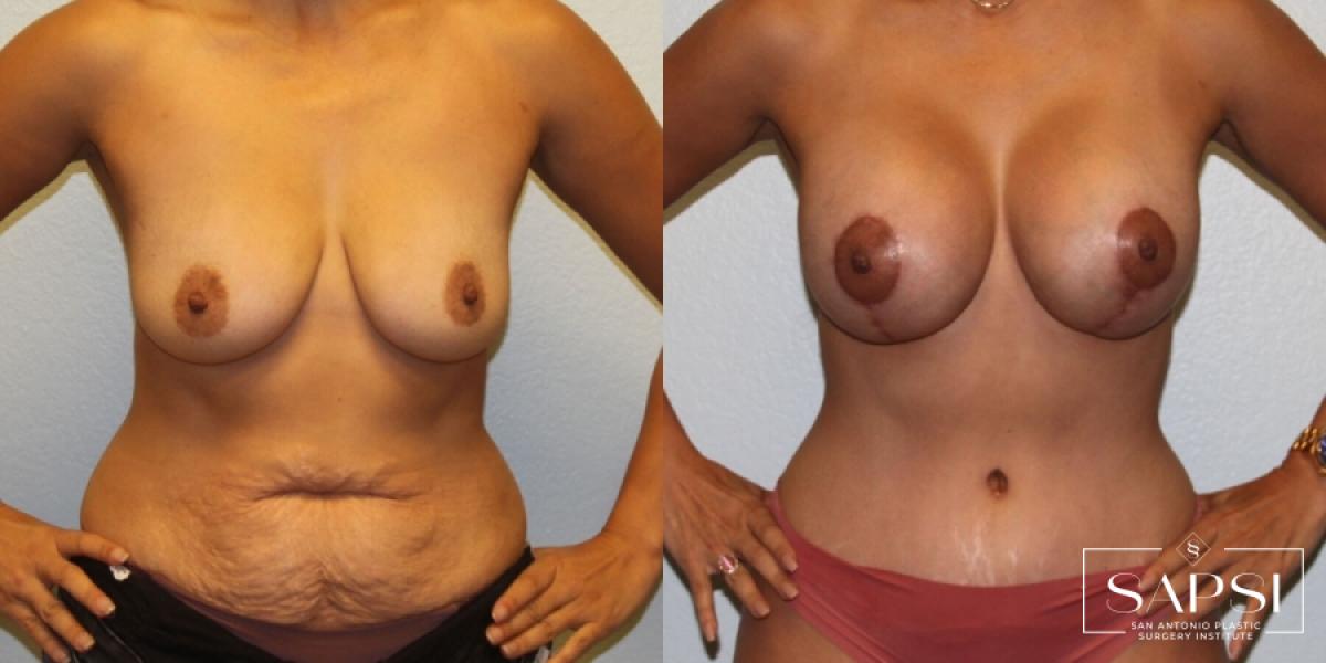 Body Contouring: Patient 9 - Before and After  