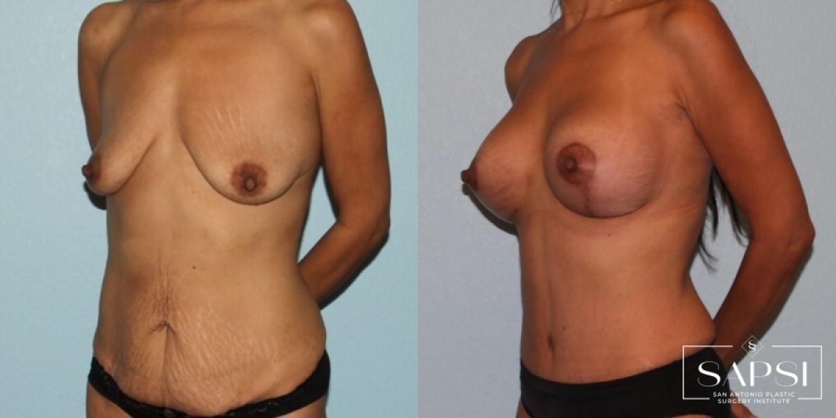 Breast Augmentation With Lift: Patient 5 - Before and After 2