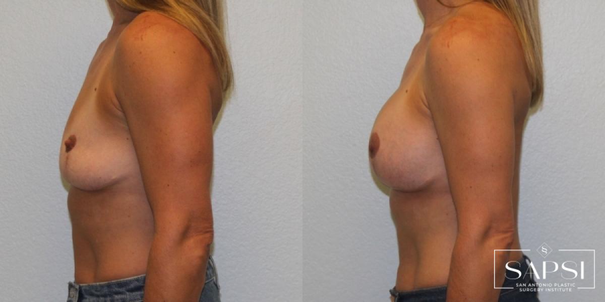 Breast Augmentation: Patient 58 - Before and After 3