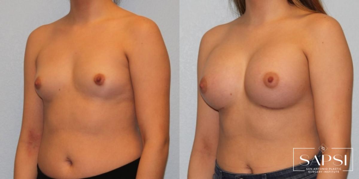 Breast Augmentation: Patient 35 - Before and After 2