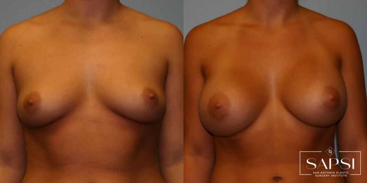 Breast Augmentation: Patient 7 - Before and After  