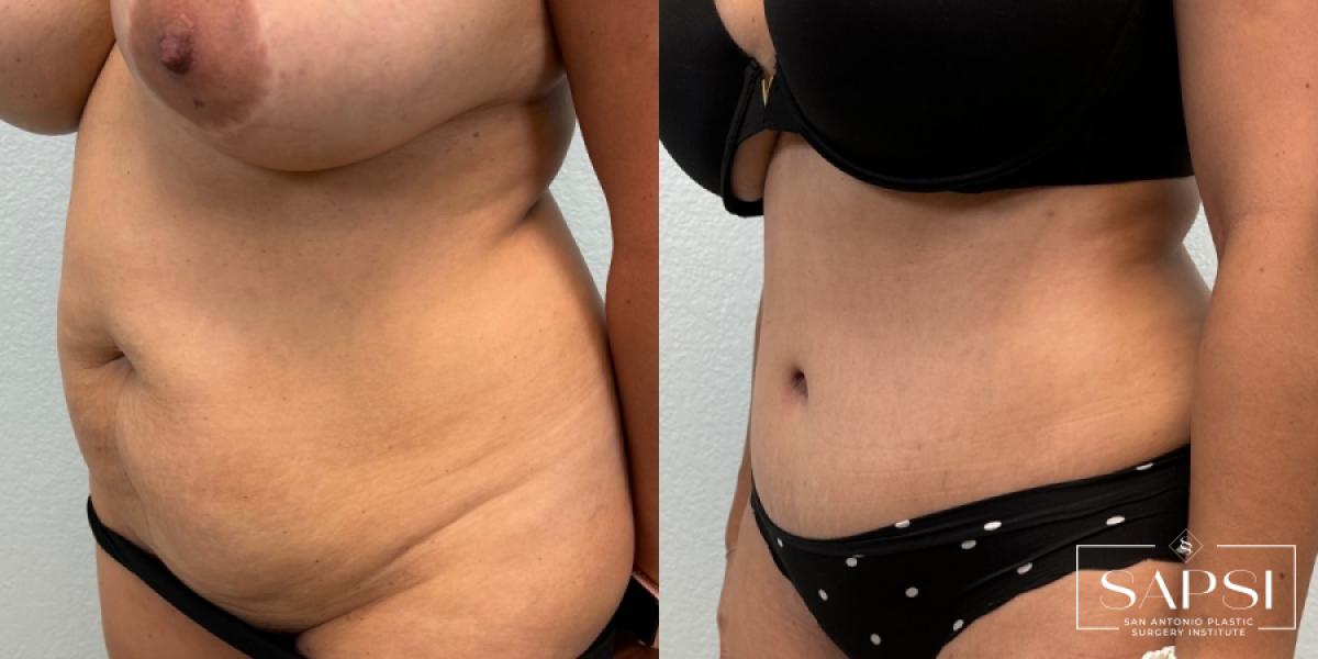 Tummy Tuck: Patient 2 - Before and After 2