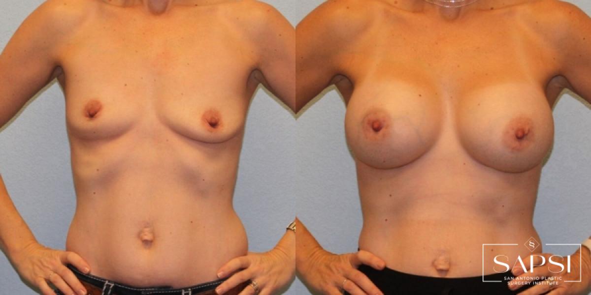 Breast Augmentation: Patient 48 - Before and After 1