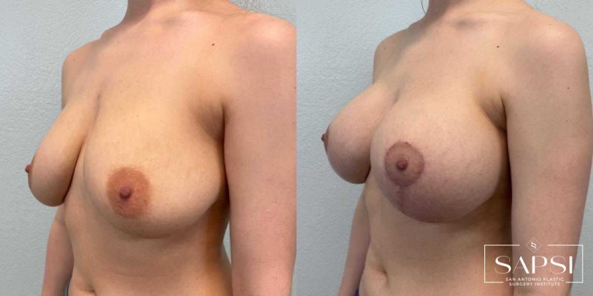 Breast Augmentation With Lift: Patient 24 - Before and After 2