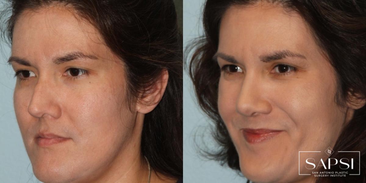 Facelift: Patient 1 - Before and After 2