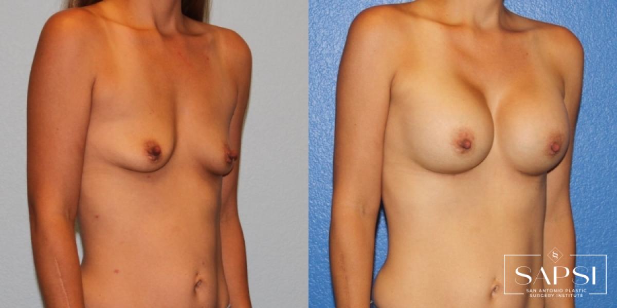 Breast Augmentation: Patient 21 - Before and After 2