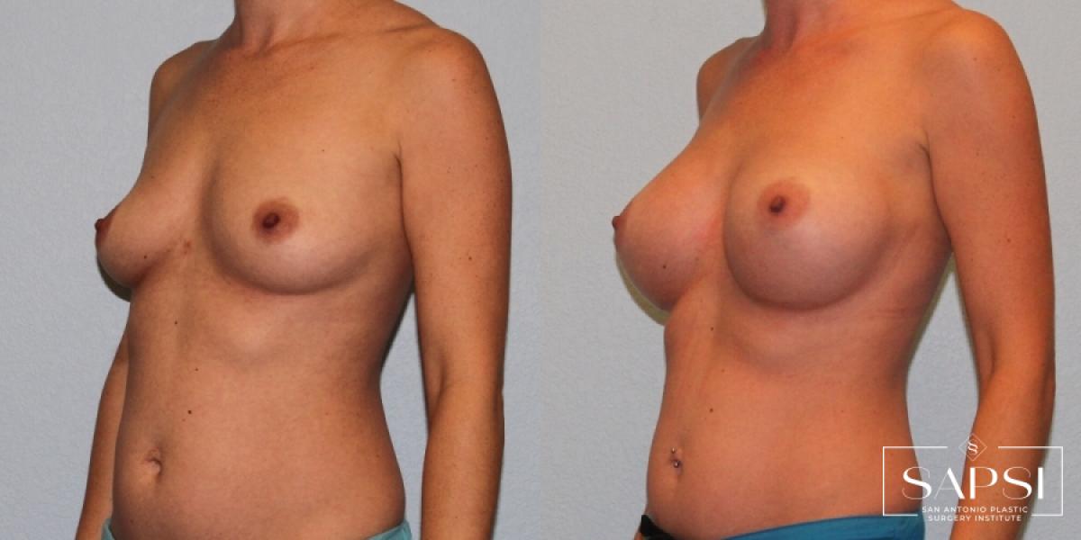 Breast Augmentation: Patient 18 - Before and After 2