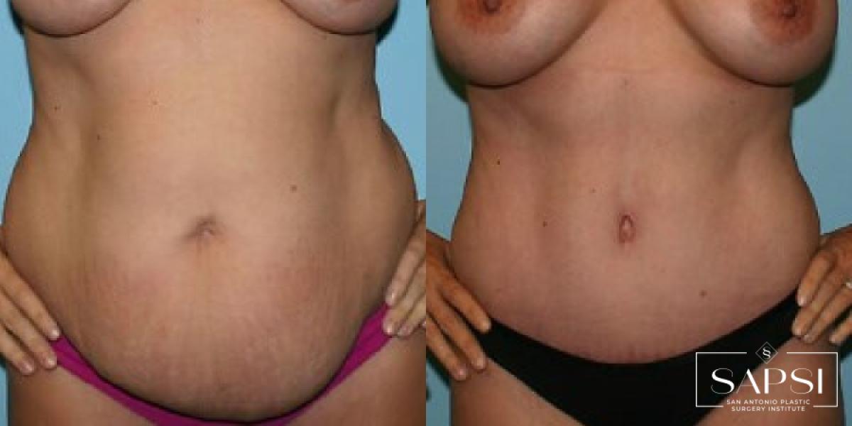 Tummy Tuck: Patient 40 - Before and After 1