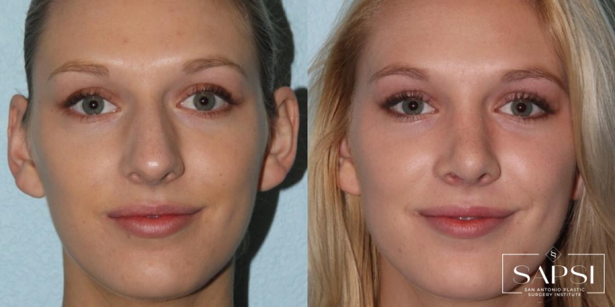 Facelift: Patient 2 - Before and After  