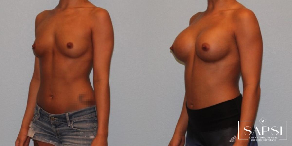 Breast Augmentation: Patient 37 - Before and After 2