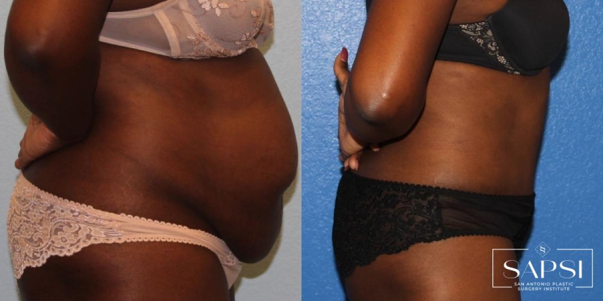 Tummy Tuck: Patient 18 - Before and After 3