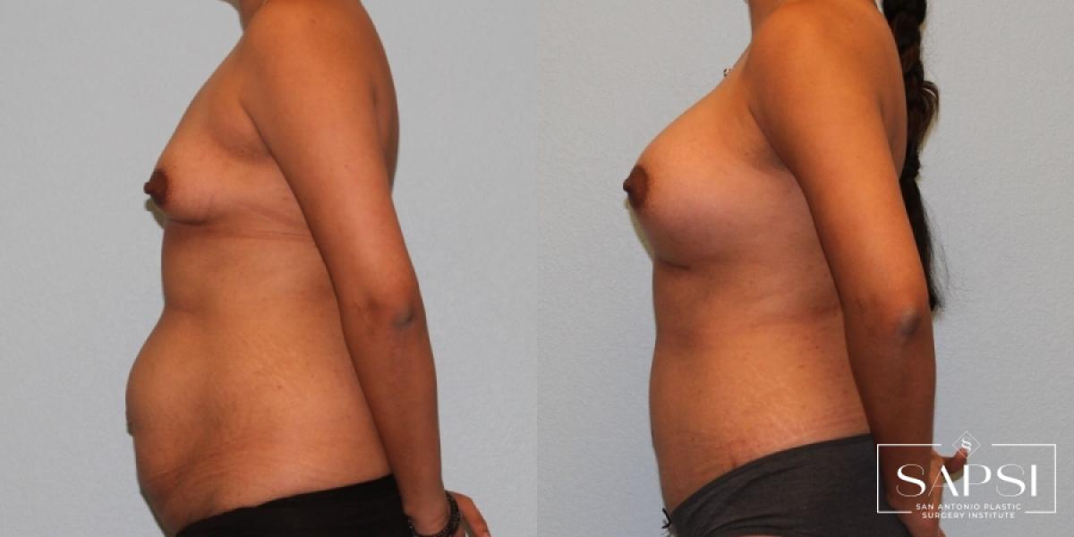 Tummy Tuck: Patient 47 - Before and After 3