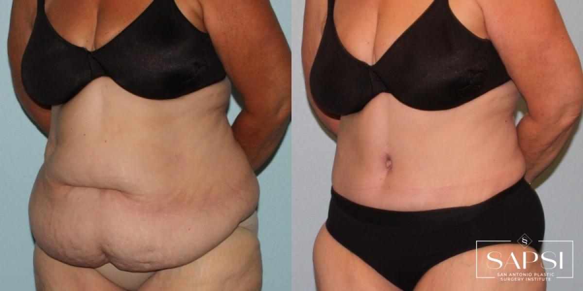 Liposuction: Patient 15 - Before and After 2