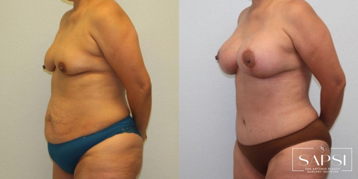 Breast Augmentation With Lift: Patient 17 - Before and After 2