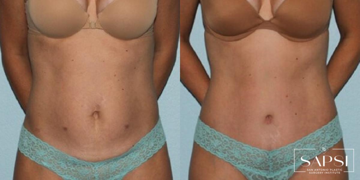 Tummy Tuck: Patient 29 - Before and After 1