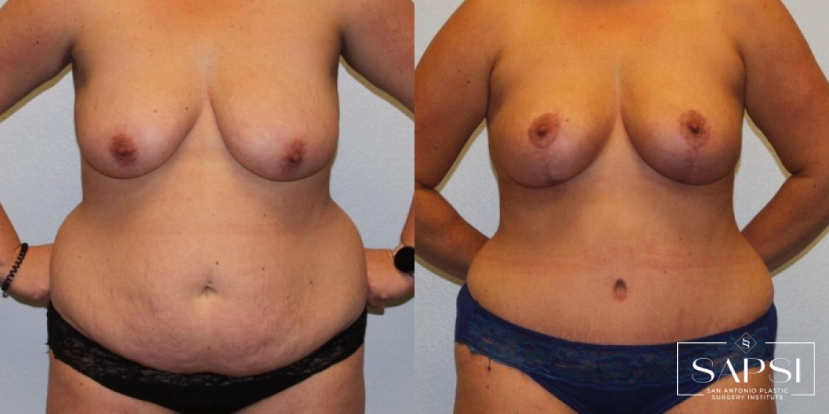 Body Contouring: Patient 5 - Before and After  