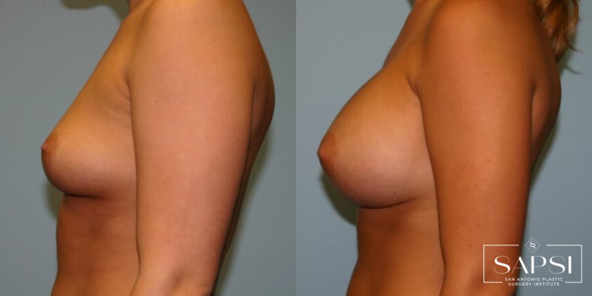 Breast Augmentation: Patient 7 - Before and After 3