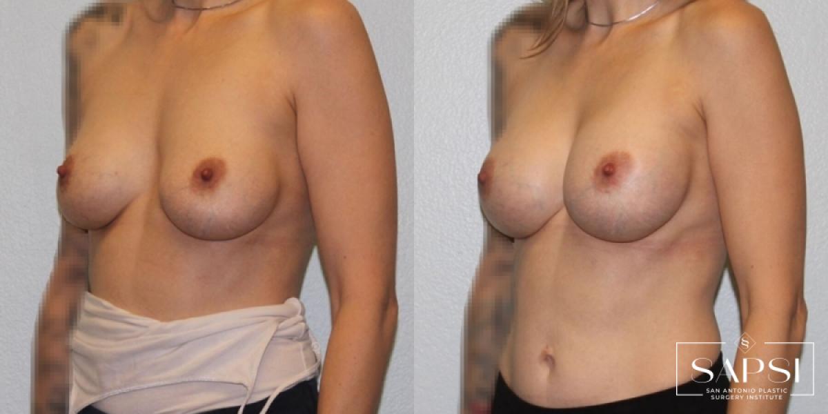 Breast Revision: Patient 6 - Before and After 2