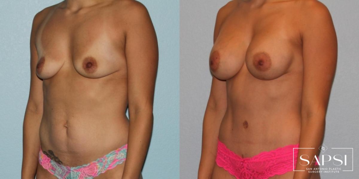 Tummy Tuck: Patient 32 - Before and After 2