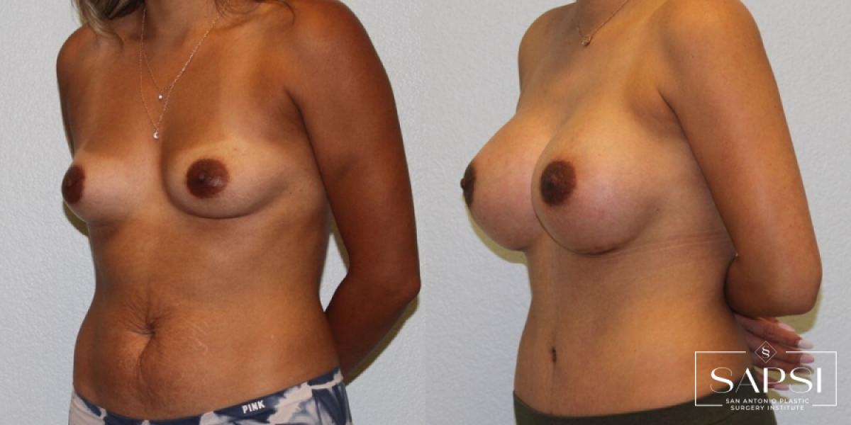 Breast Augmentation: Patient 64 - Before and After 2