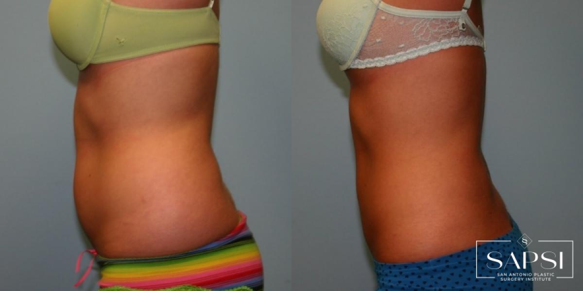 Liposuction: Patient 12 - Before and After 2