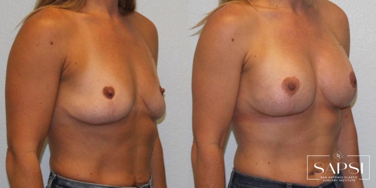 Breast Augmentation: Patient 58 - Before and After 2