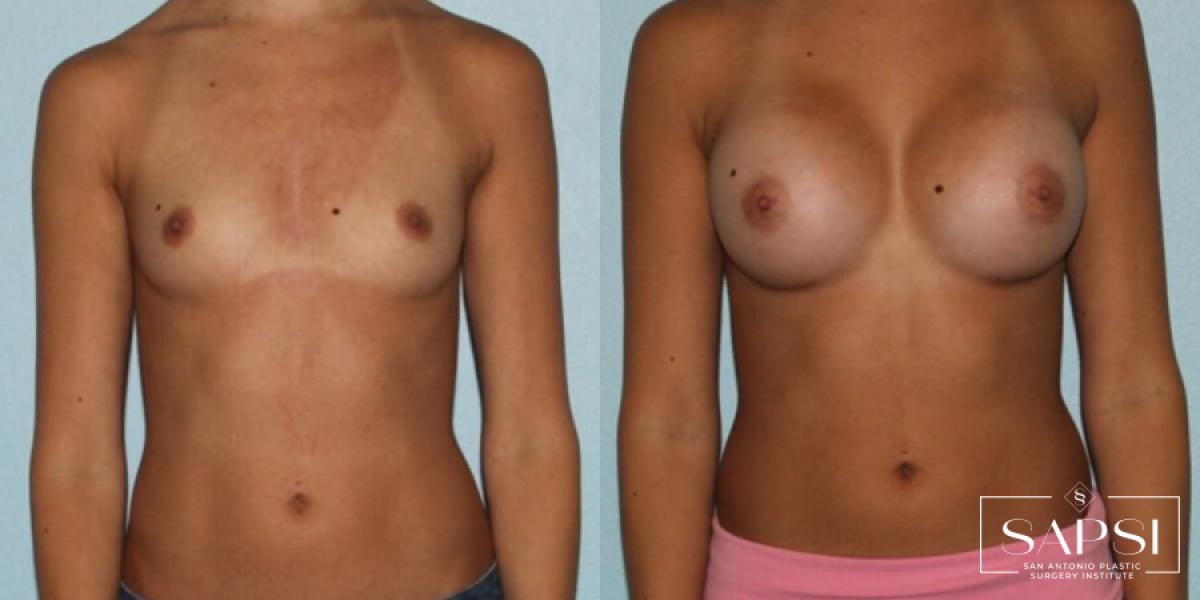 Breast Augmentation: Patient 39 - Before and After 1