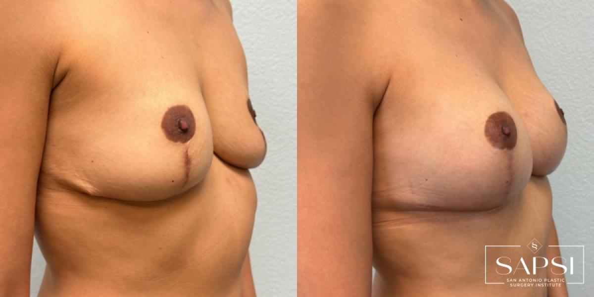 Breast Revision: Patient 11 - Before and After 2