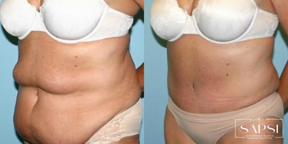 Tummy Tuck: Patient 39 - Before and After 2