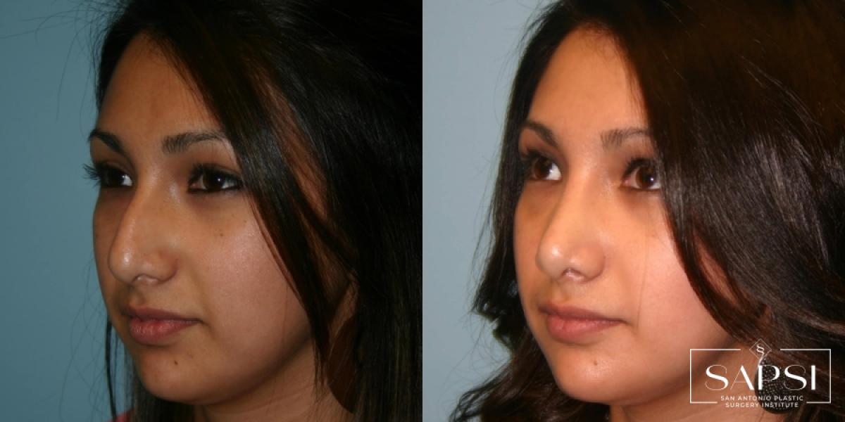 Facelift: Patient 3 - Before and After 3