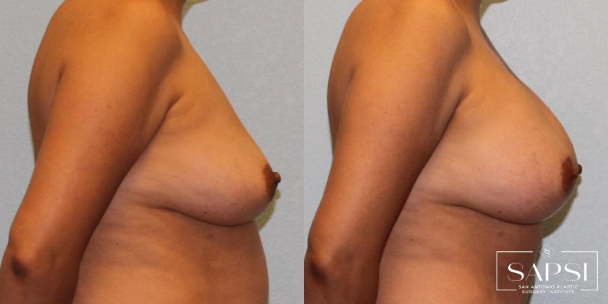 Breast Augmentation: Patient 78 - Before and After 3