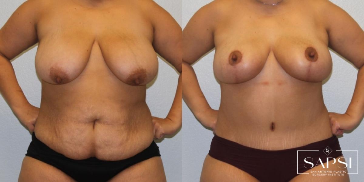 After Weight Loss: Patient 7 - Before and After  