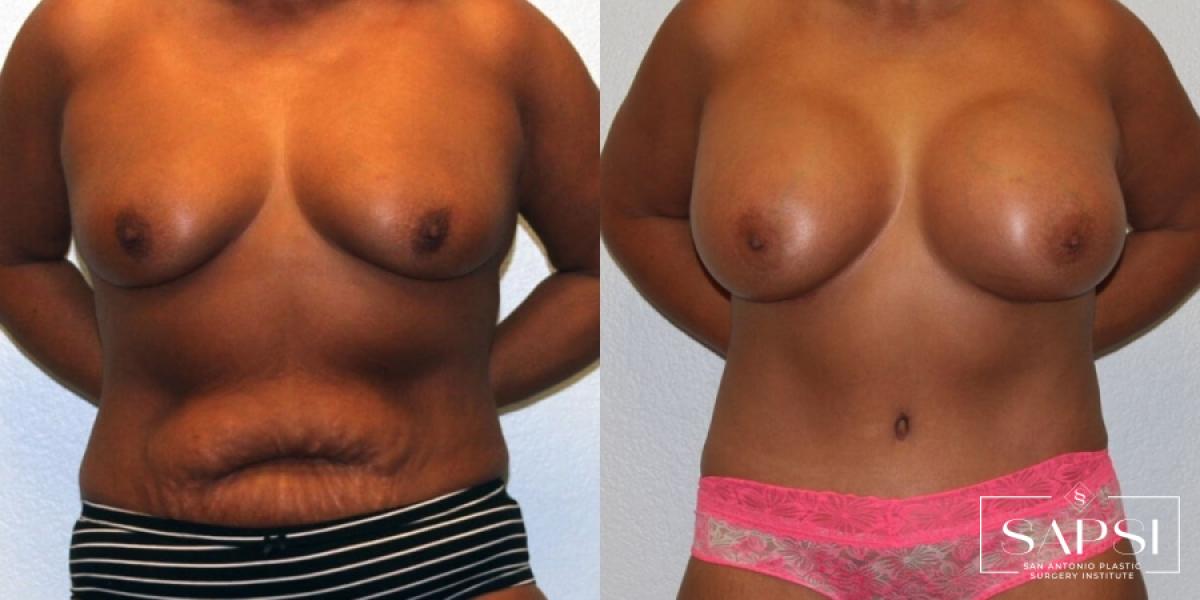 Body Contouring: Patient 6 - Before and After  