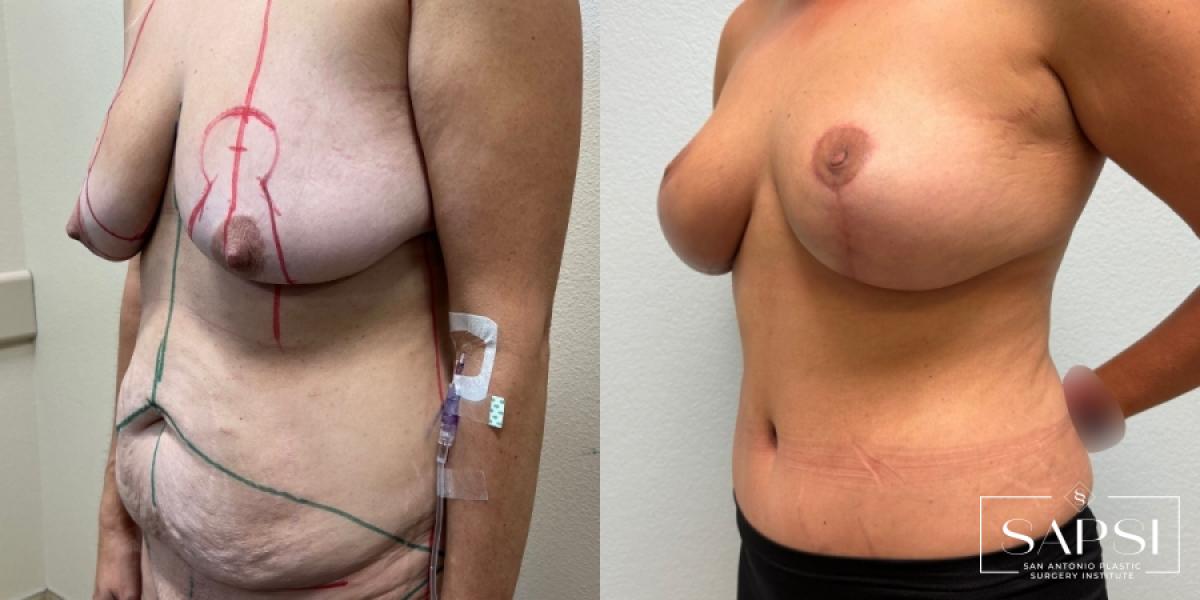 After Weight Loss: Patient 3 - Before and After 2