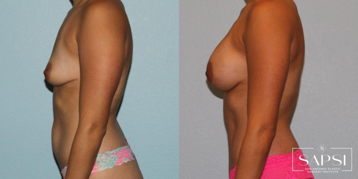 Tummy Tuck: Patient 32 - Before and After 3