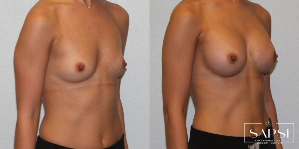 Breast Augmentation: Patient 27 - Before and After 2