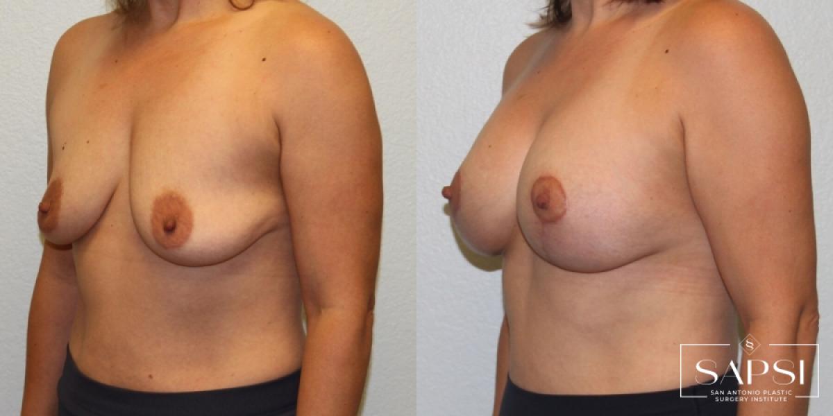 Breast Augmentation With Lift: Patient 4 - Before and After 2