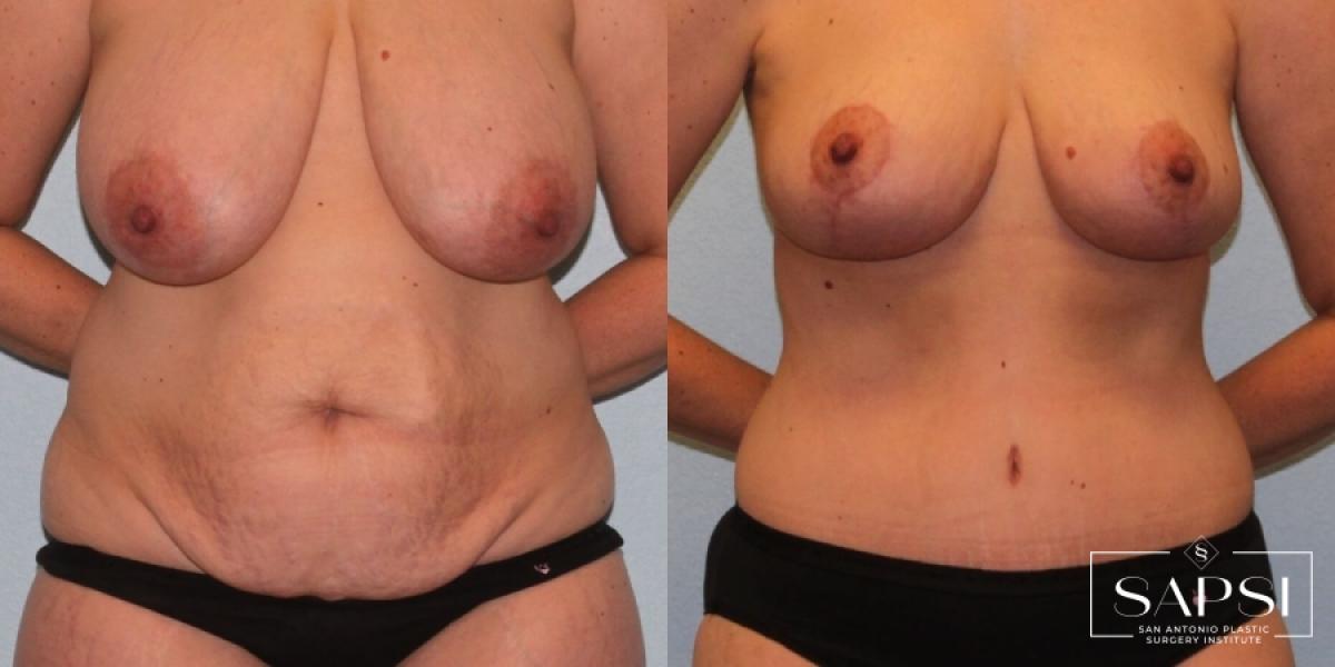 Breast Reduction: Patient 3 - Before and After  