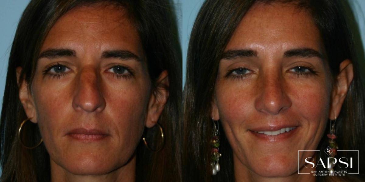 Rhinoplasty: Patient 1 - Before and After 3