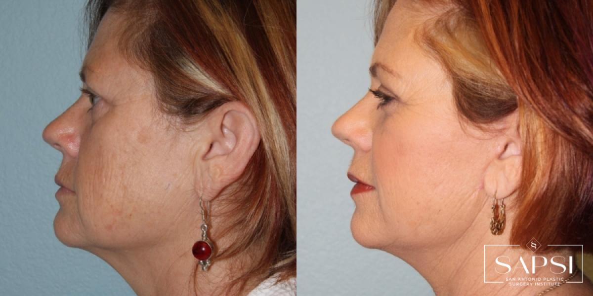 Facelift: Patient 6 - Before and After 3