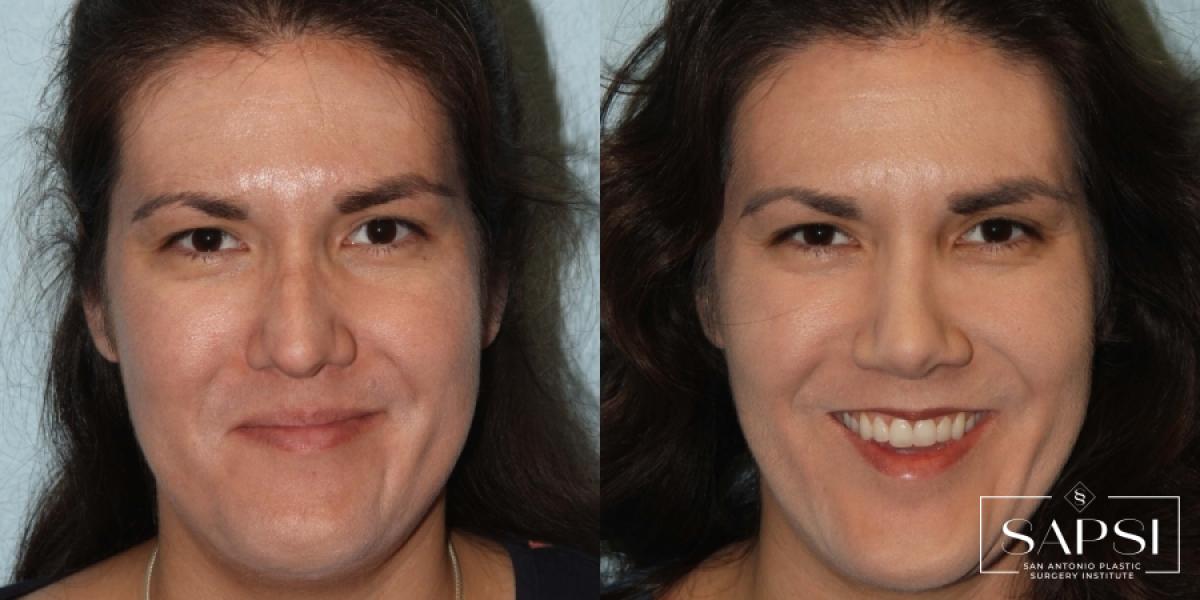 Facelift: Patient 1 - Before and After  